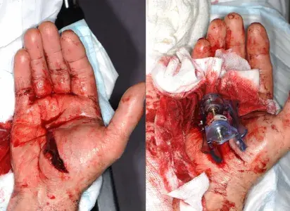 ItClamp cerrando una herida abierta