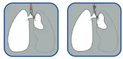 Ventrain en pulmón no dependiente 