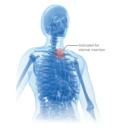 Fast1 Sistema intraóseo esternal