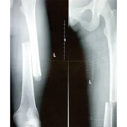 Férula de tracción CT-7