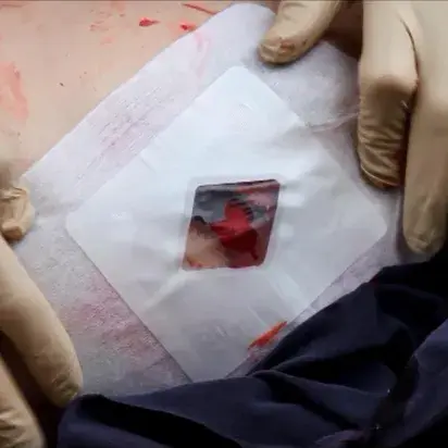 Apósito torácico Russel