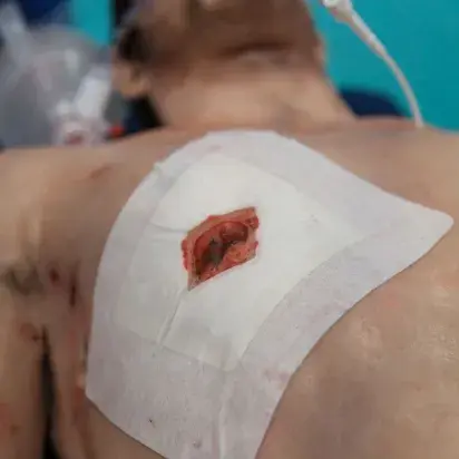 Apósito torácico Russel